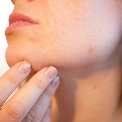 Facial Steam Treatment for Acne
