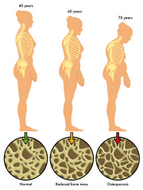 Essential oils for Osteoporosis Essential oils for Osteoporosis