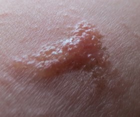 Natural Home Remedies for Poison Ivy & Tips for Immunity